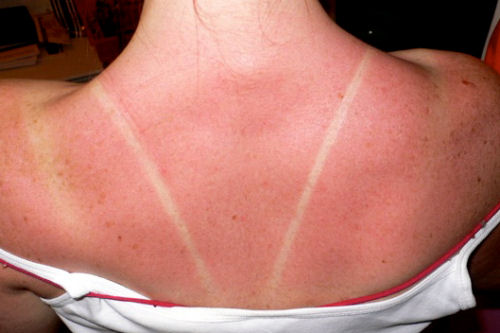 use tea bags on sunburn